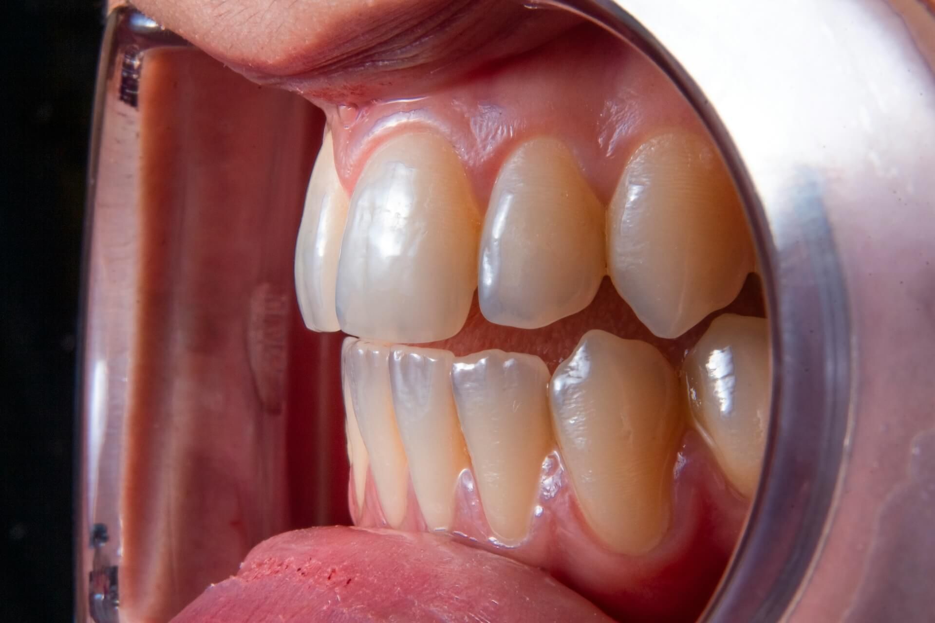 A close-up view showing areas of gum recession