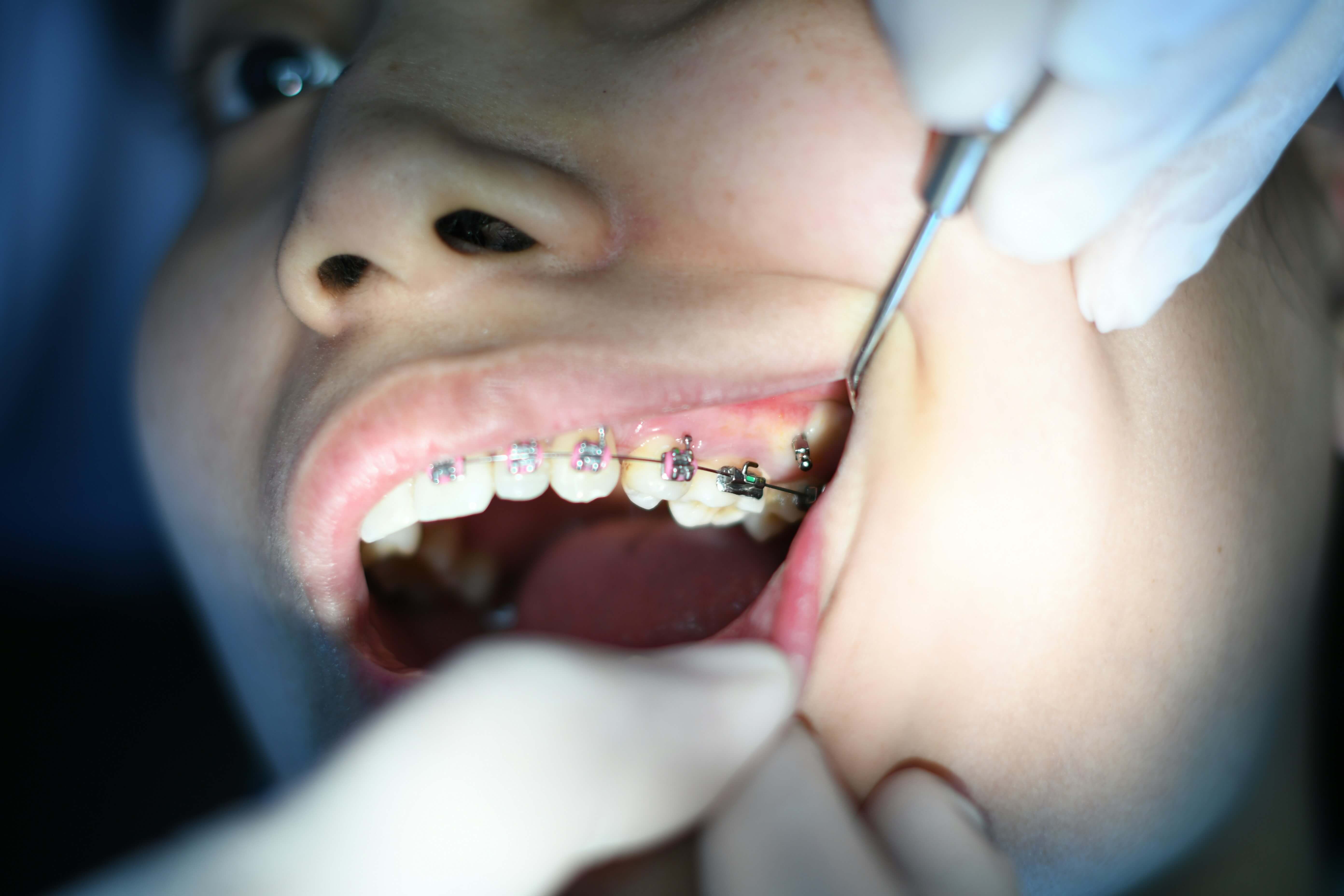 A dental professional examining a patient wearing braces